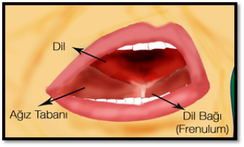 Dil bağı (Ankiloglossi) nedir? - Op. Dr. Yusuf Orhan Uçal